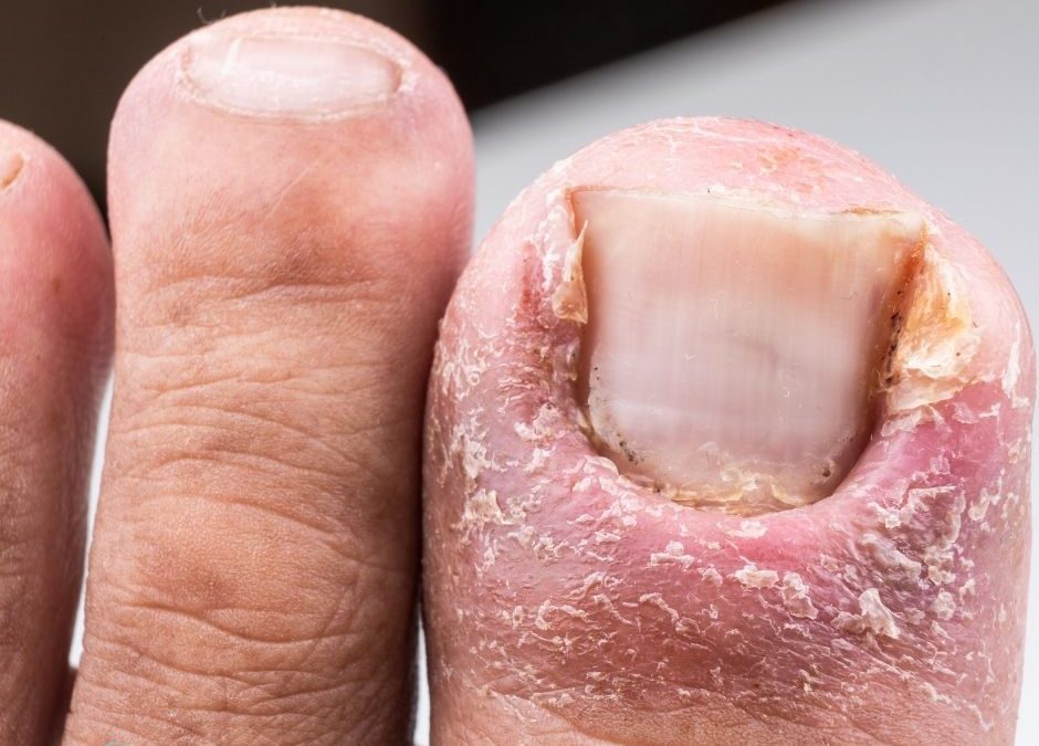 Ungla encarnada a Badalona: què fer si et fa mal el dit del peu?