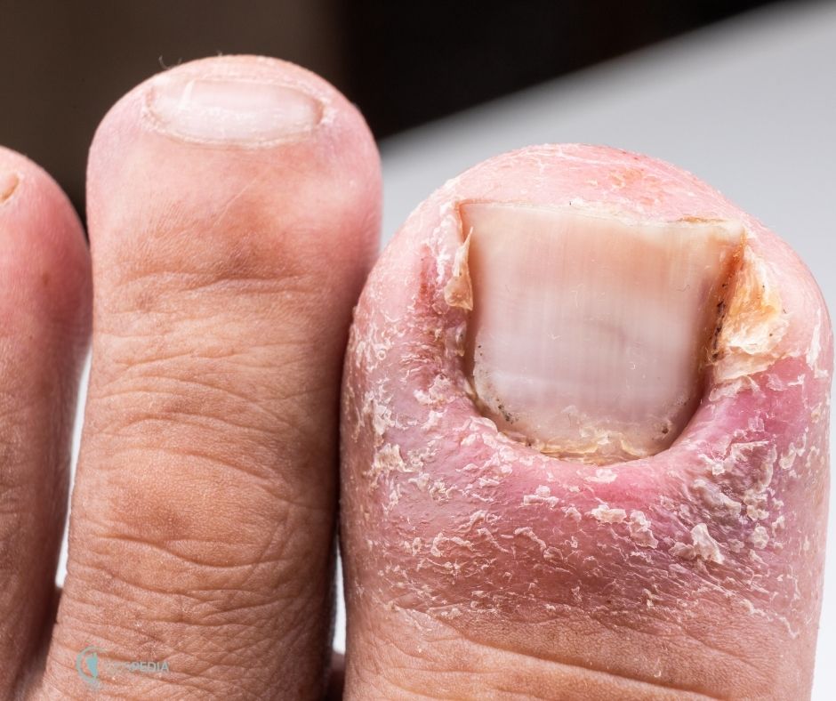 ungla encarnada a Badalona