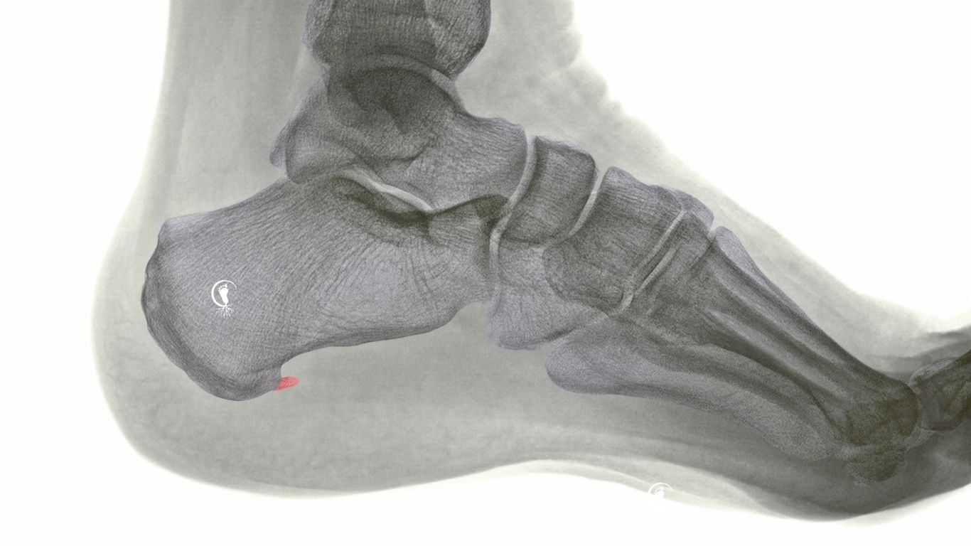 Esperó calcani - Espolón calcaneo