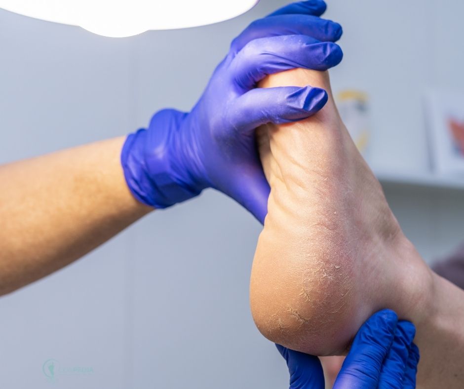 Podòloga tractant clivelles als talons i sequedat als peus a Badalona